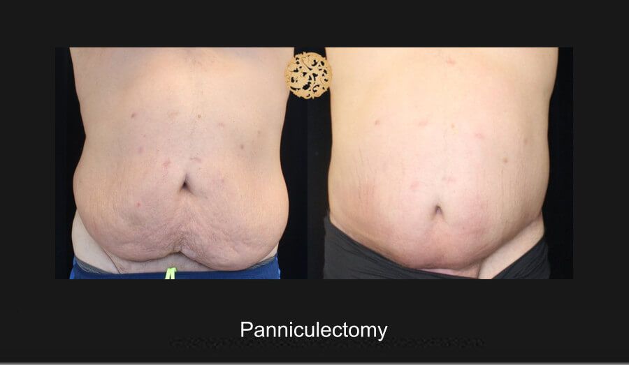 Panniculectomy Before & After