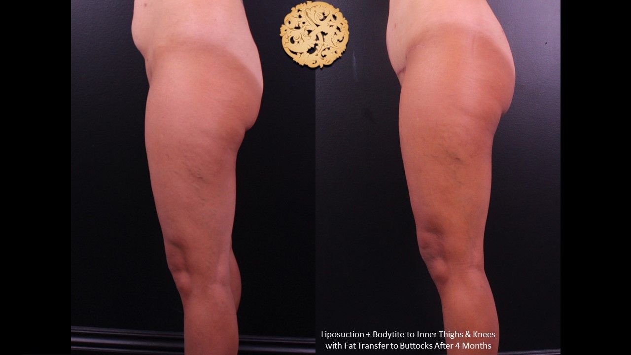 Brazillian Butt Lift Before & After