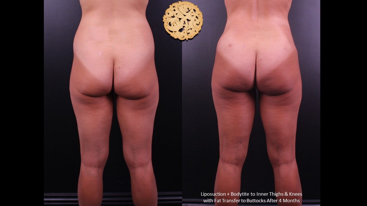 Brazillian Butt Lift Before & After