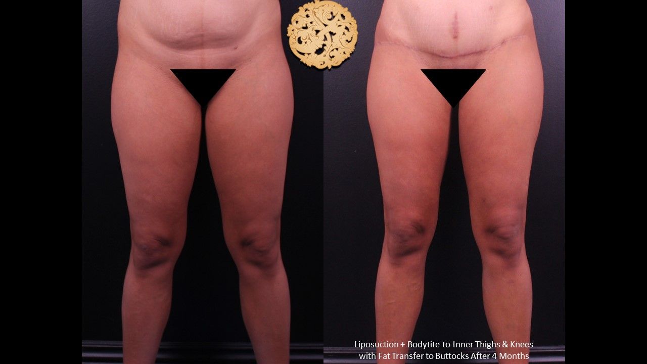 Brazillian Butt Lift Before & After