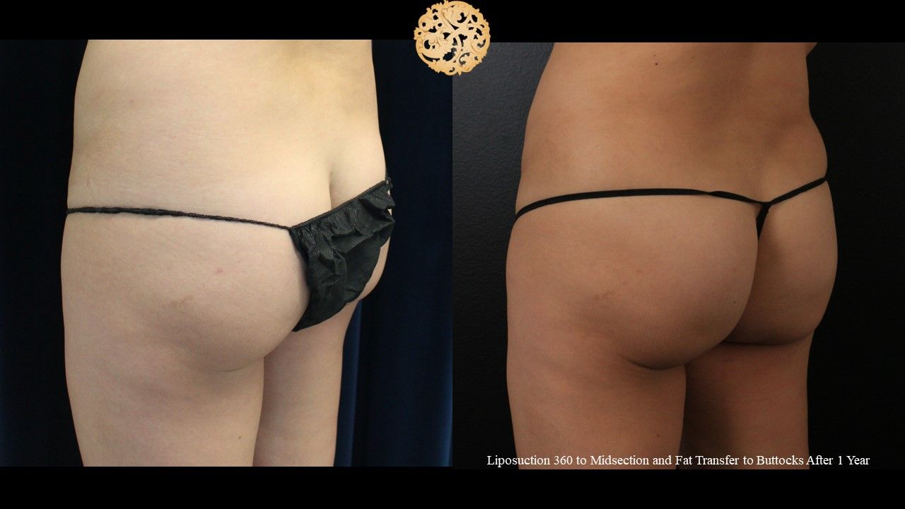 Brazillian Butt Lift Before & After