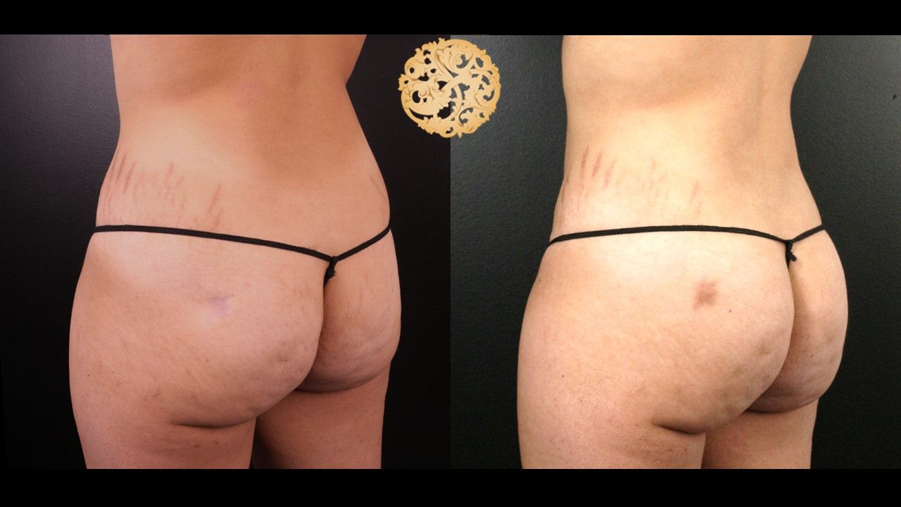Brazillian Butt Lift Before & After