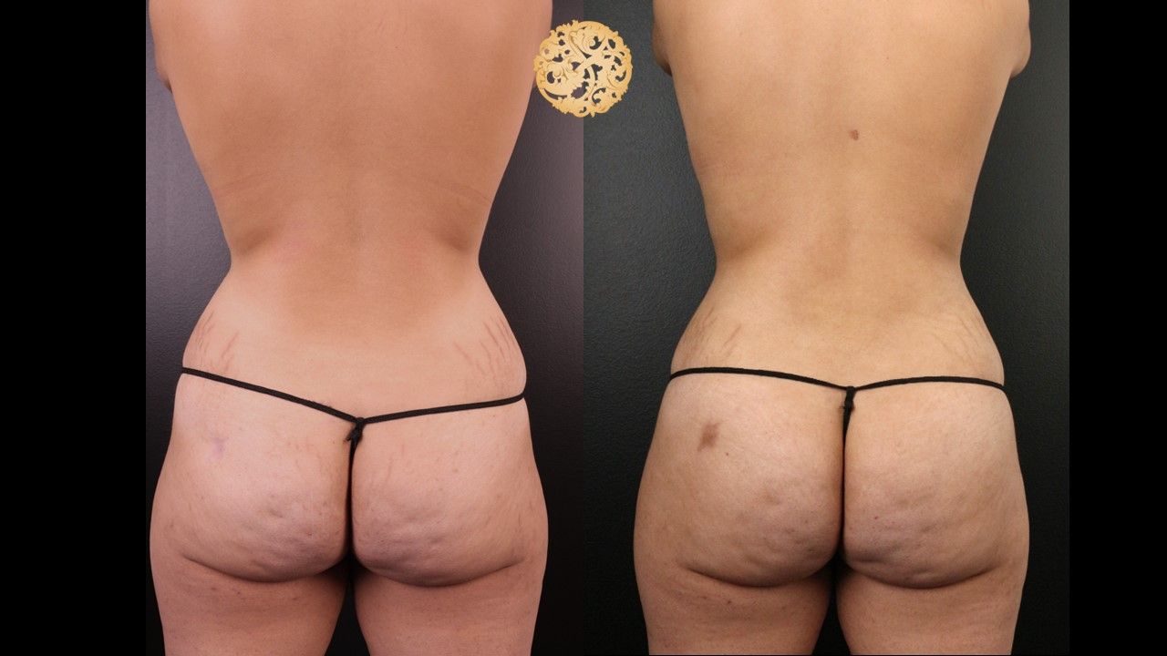 Brazillian Butt Lift Before & After