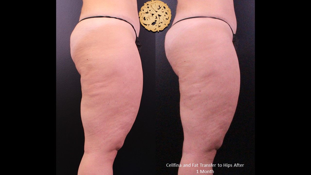 Brazillian Butt Lift Before & After