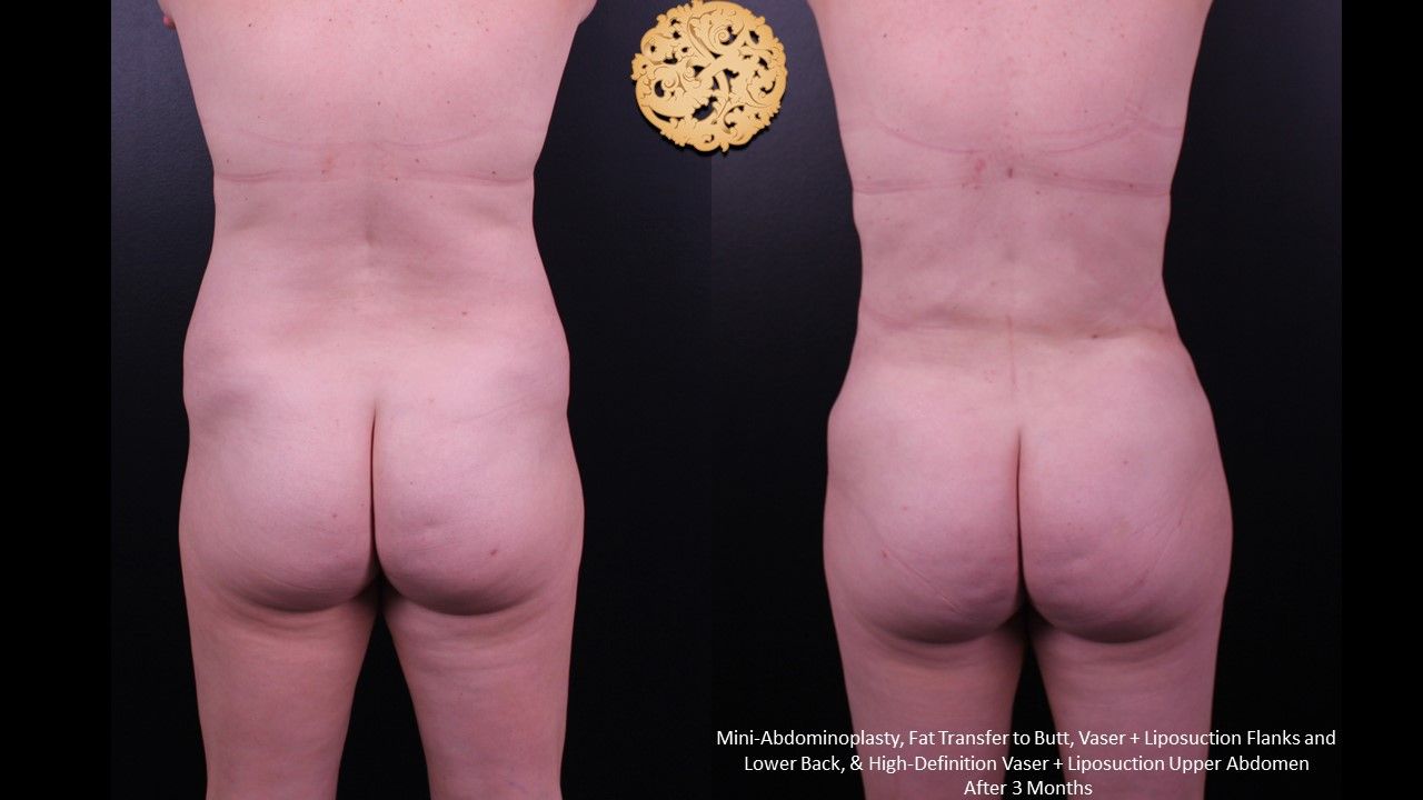 Brazillian Butt Lift Before & After