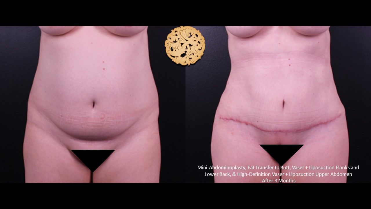 Brazillian Butt Lift Before & After