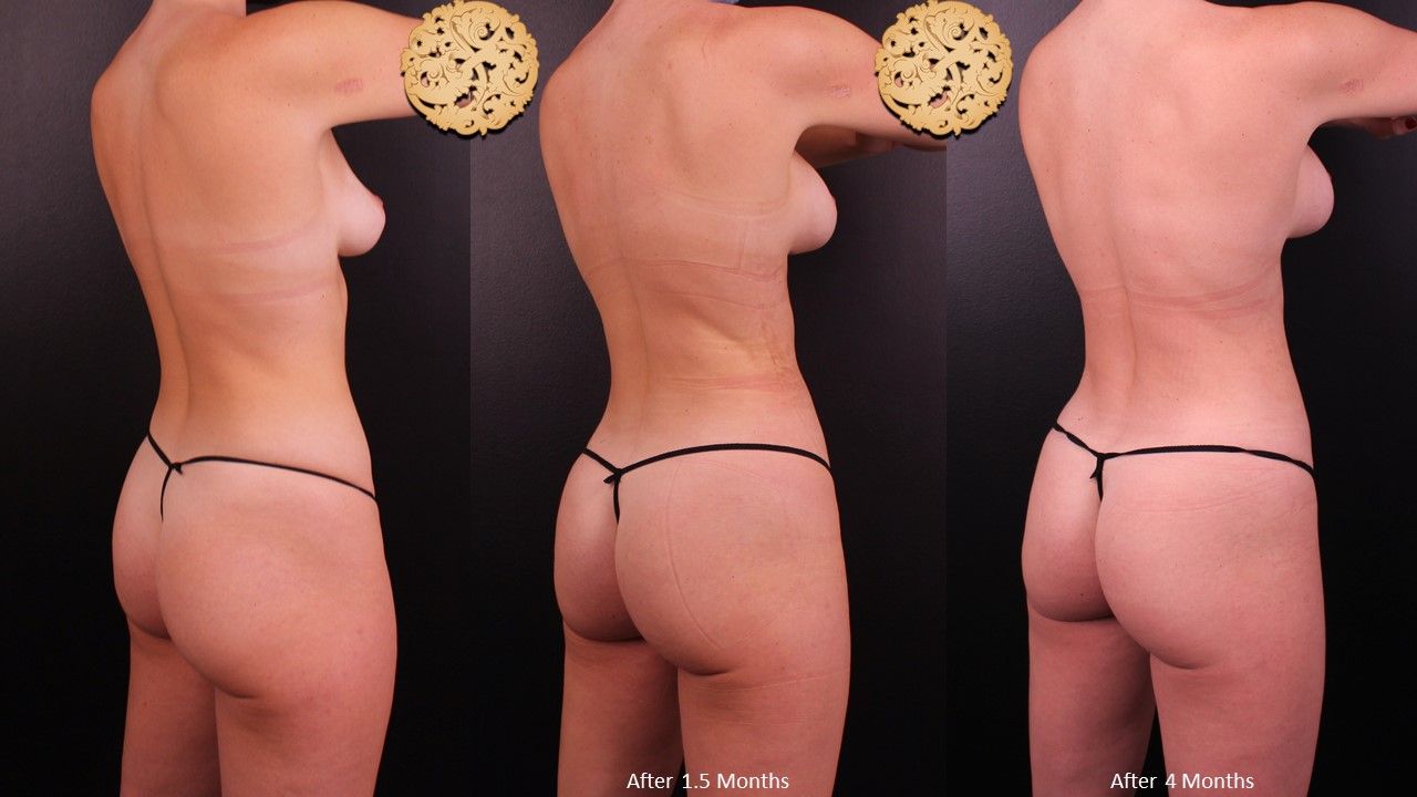 Brazillian Butt Lift Before & After
