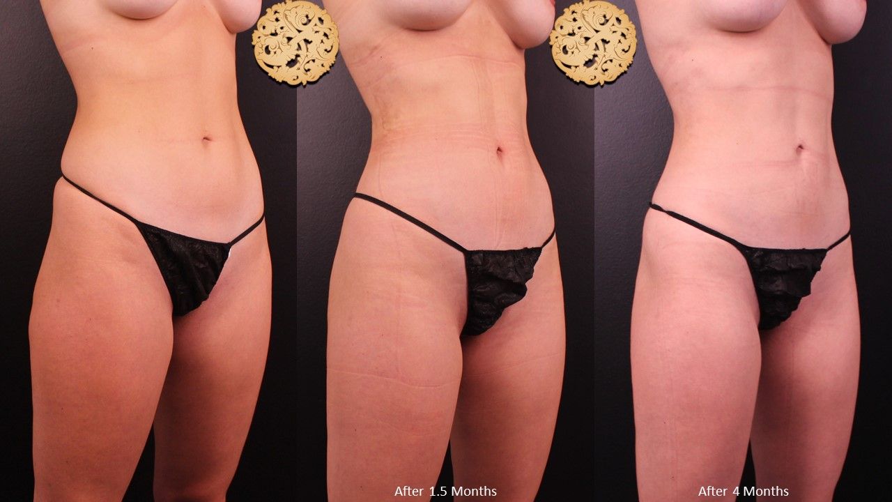 Brazillian Butt Lift Before & After