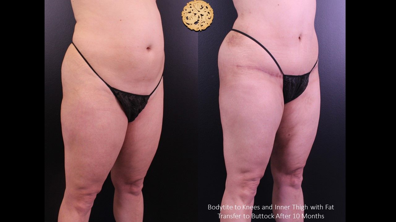 Brazillian Butt Lift Before & After