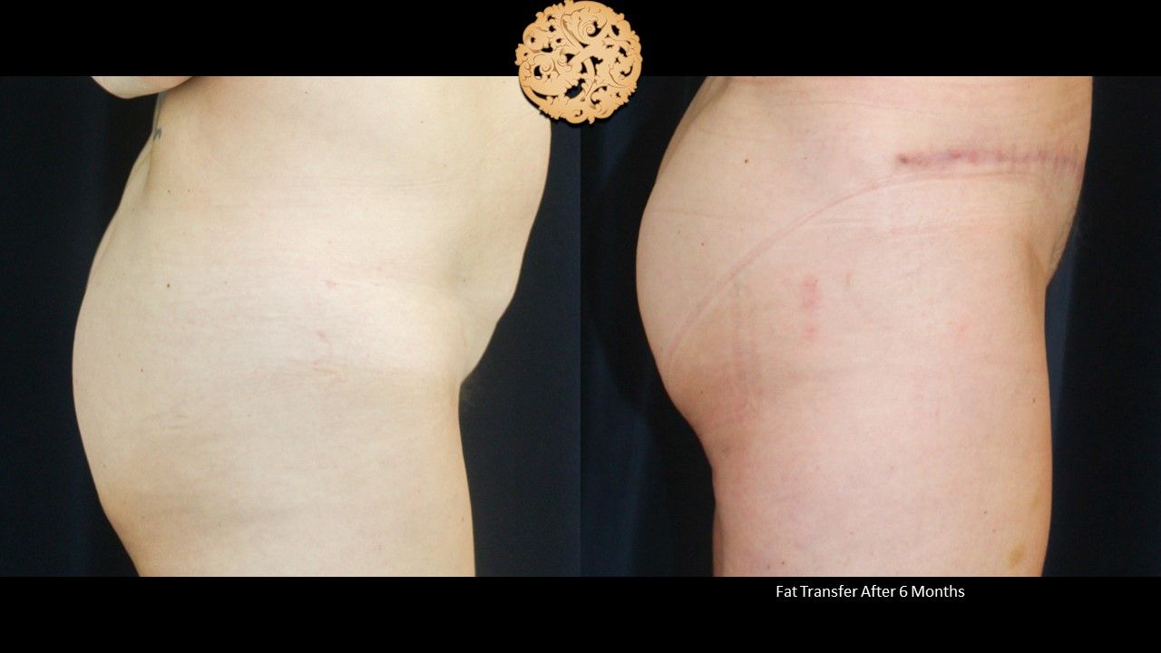 Brazillian Butt Lift Before & After