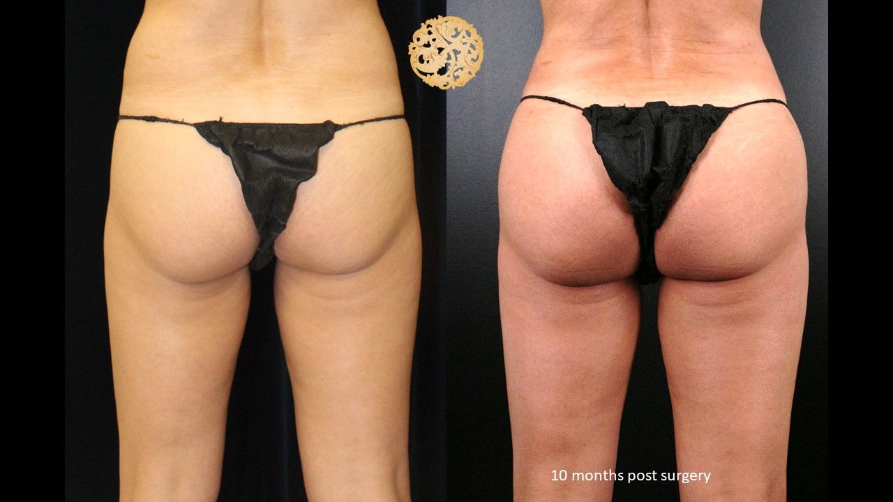 Brazillian Butt Lift Before & After