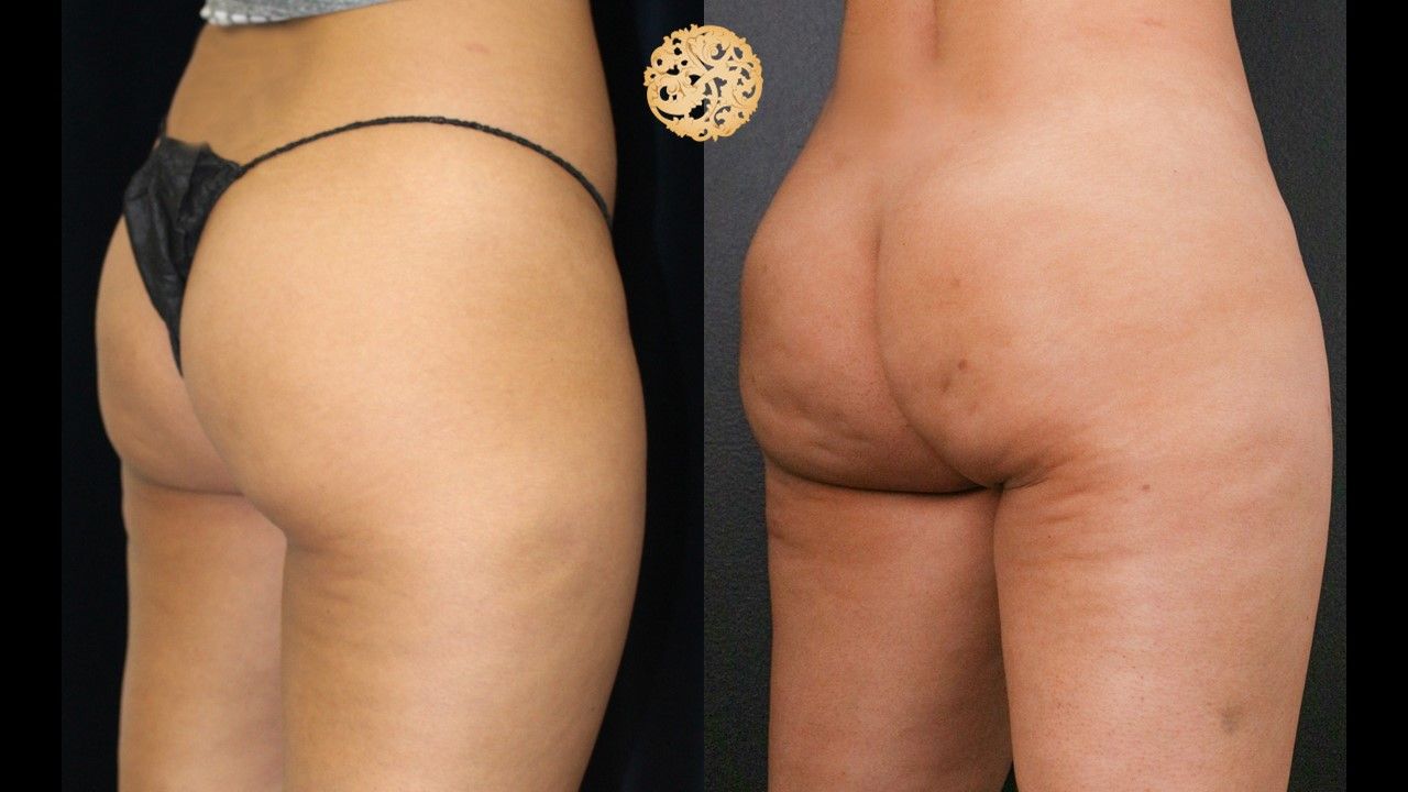 Brazillian Butt Lift Before & After