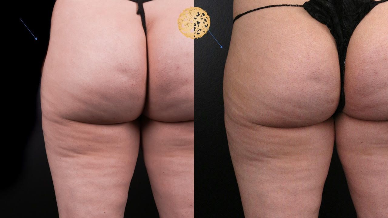 Brazillian Butt Lift Before & After