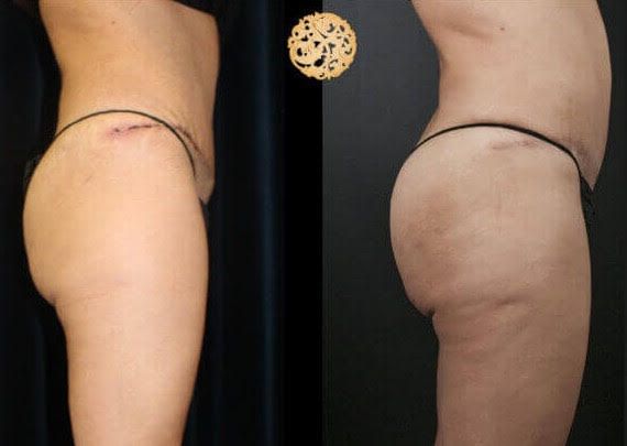 Brazillian Butt Lift Before & After