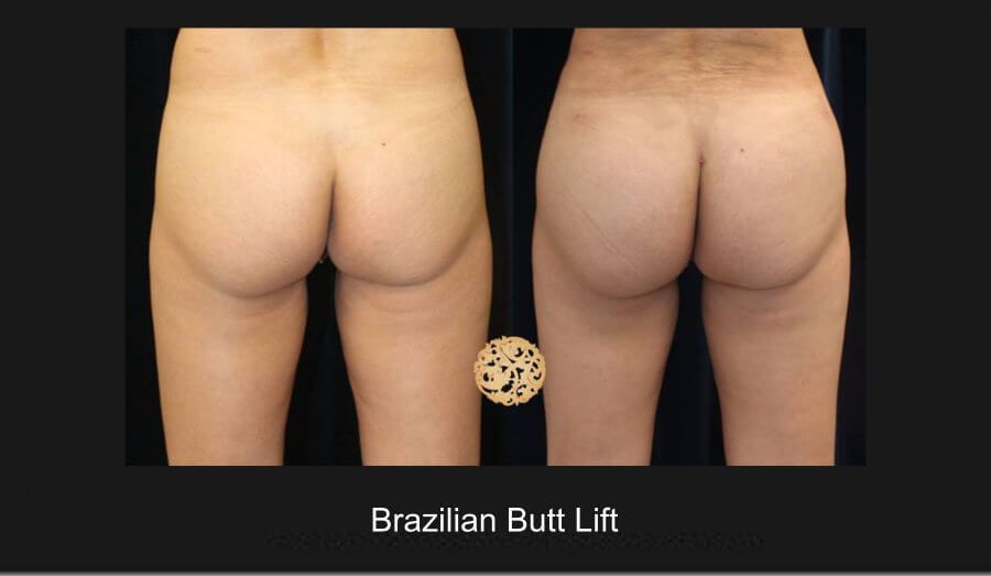 Brazillian Butt Lift Before & After