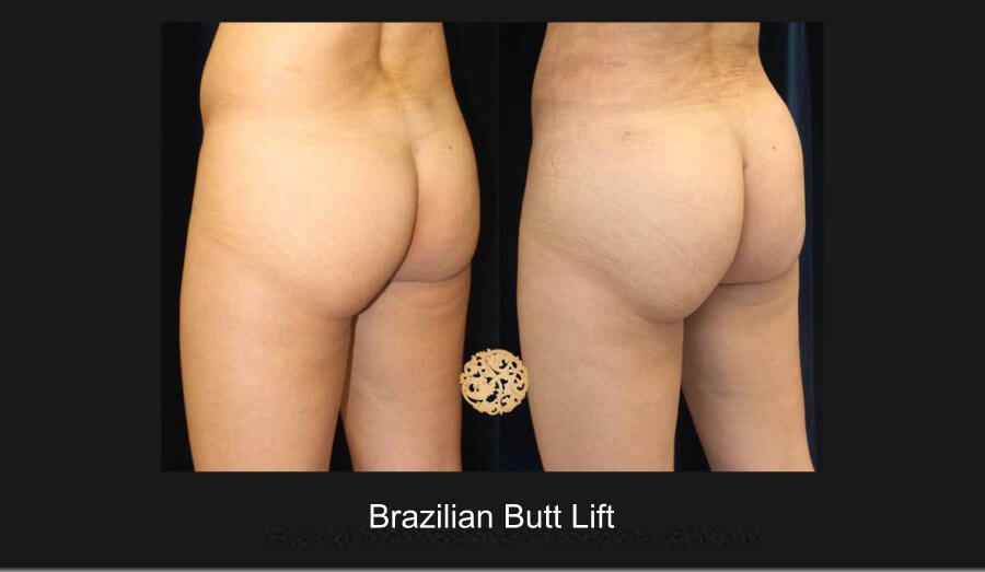Brazillian Butt Lift Before & After