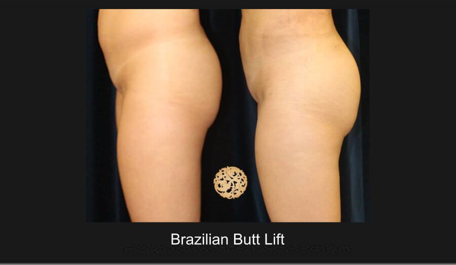 Brazillian Butt Lift Before & After