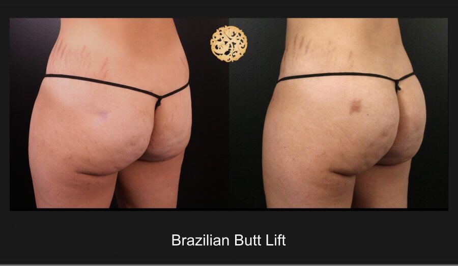 Brazillian Butt Lift Before & After