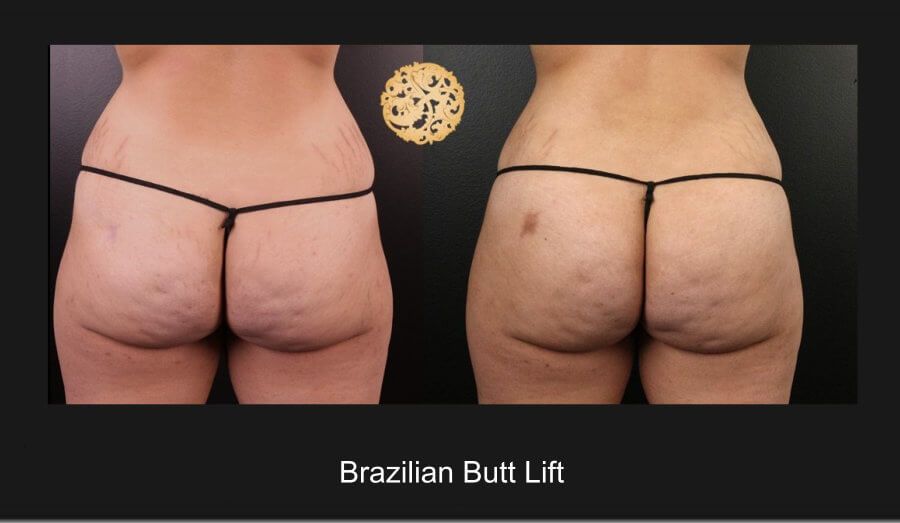 Brazillian Butt Lift Before & After