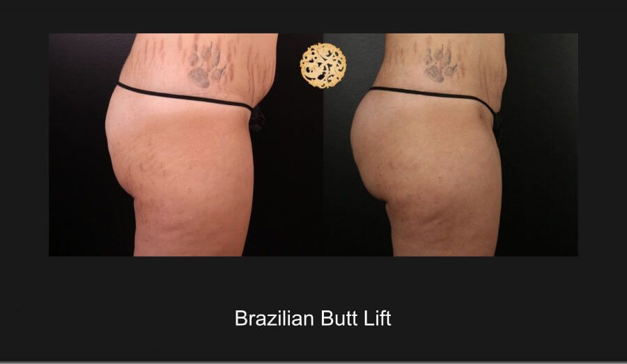 Brazillian Butt Lift Before & After
