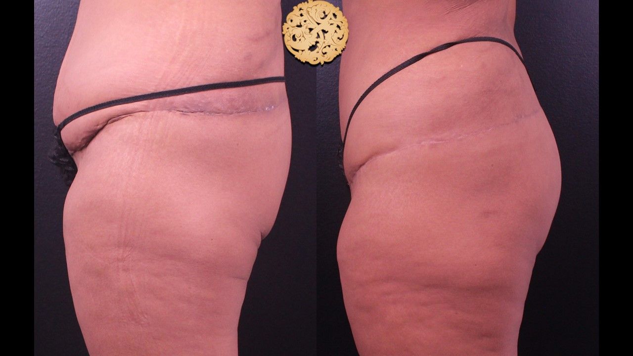 Brazillian Butt Lift Before & After