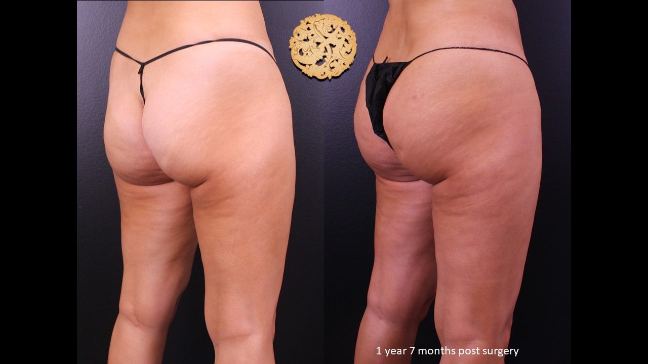 Brazillian Butt Lift Before & After