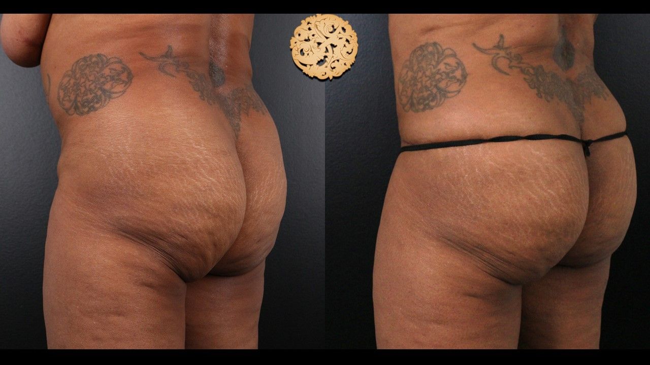 Brazillian Butt Lift Before & After