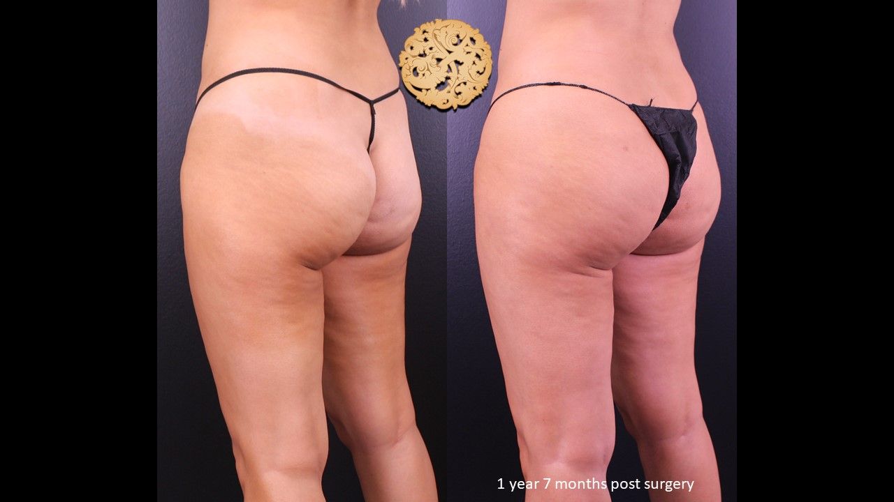 Brazillian Butt Lift Before & After