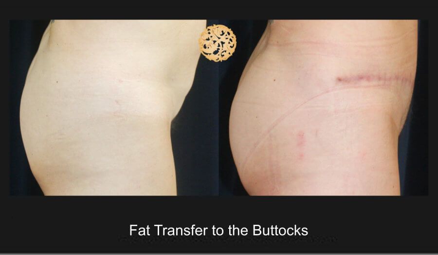 Brazillian Butt Lift Before & After