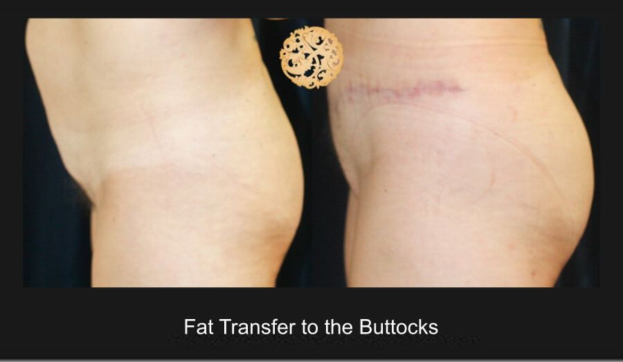 Brazillian Butt Lift Before & After