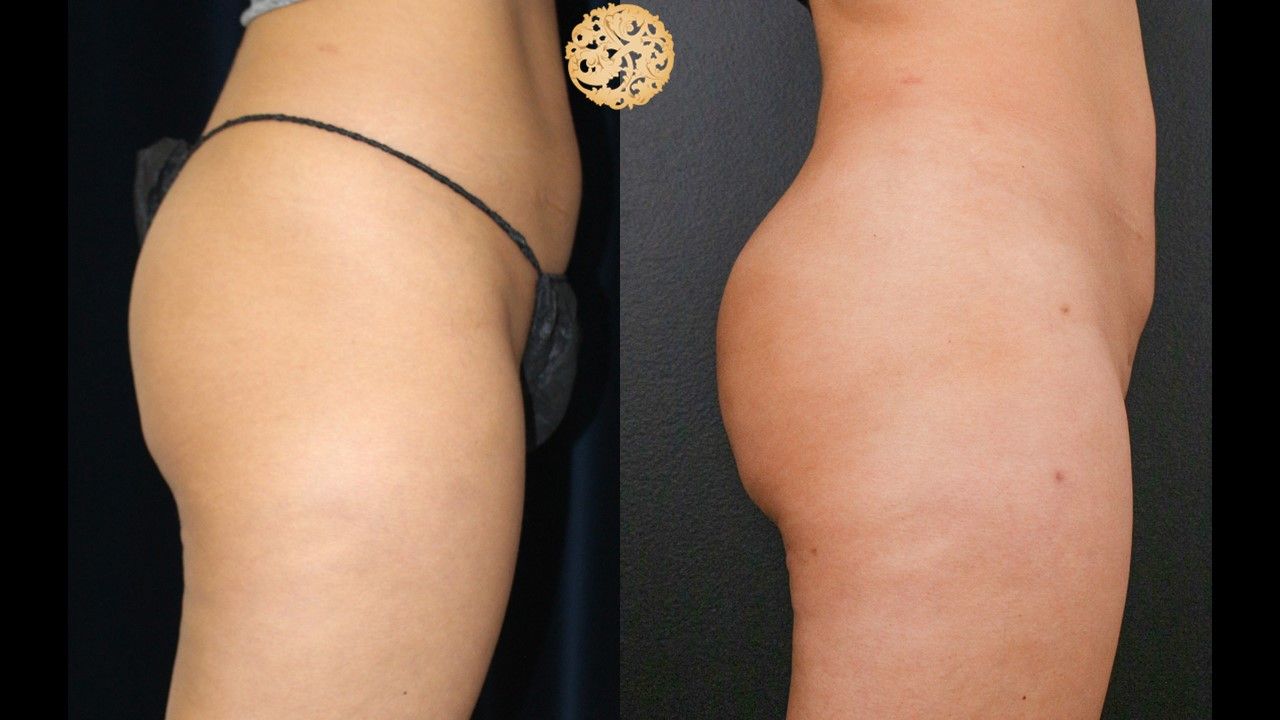 Brazillian Butt Lift Before & After