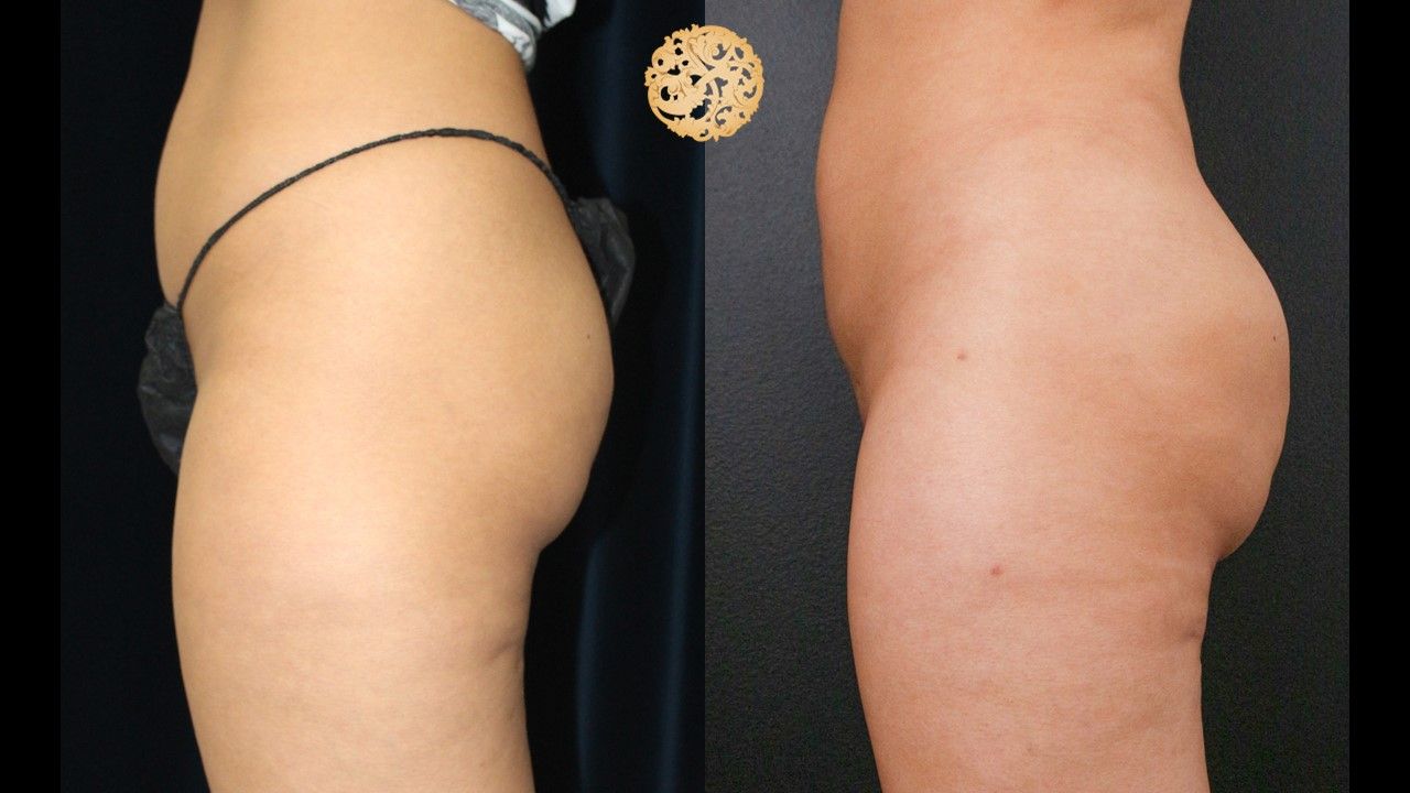 Brazillian Butt Lift Before & After