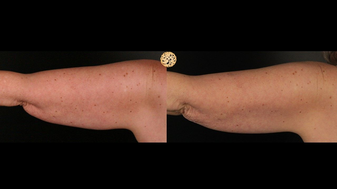 Coolsculpting Arms Before & After