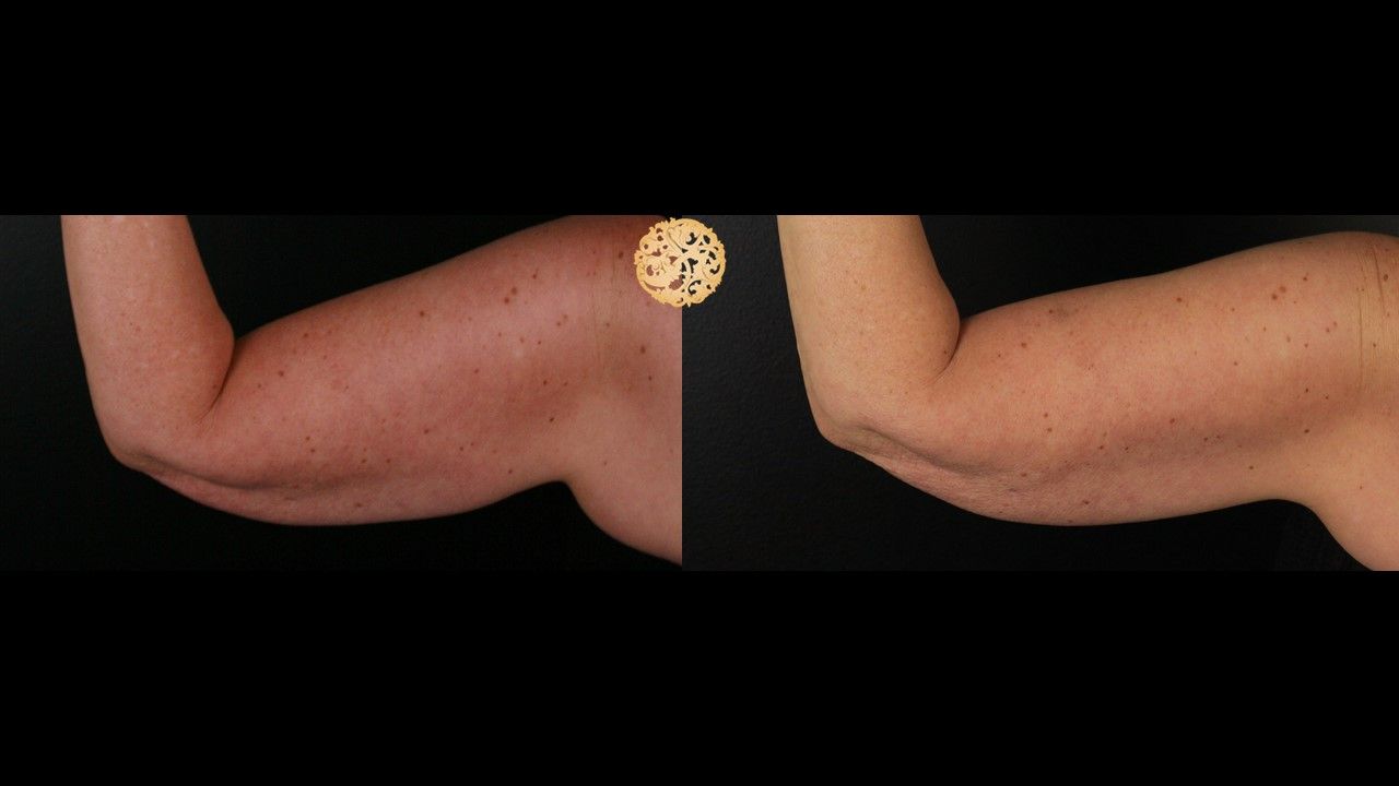 Coolsculpting Arms Before & After