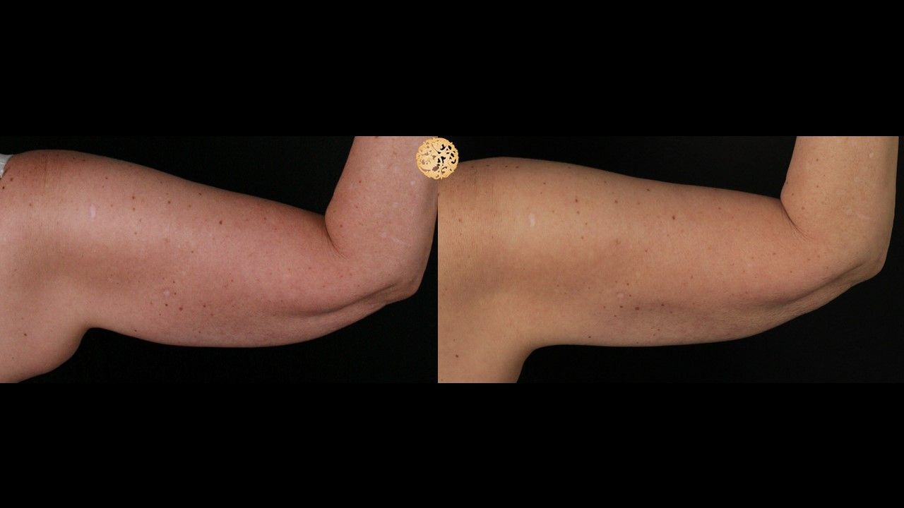 Coolsculpting Arms Before & After