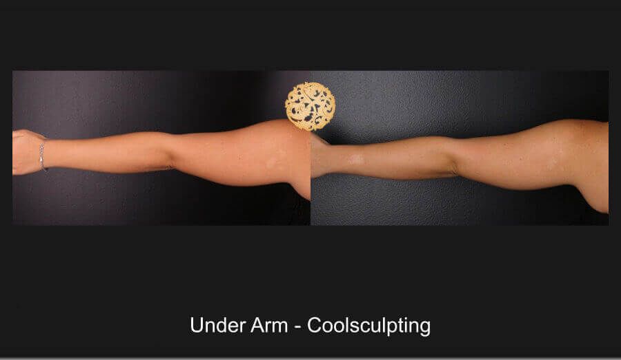 Coolsculpting Arms Before & After