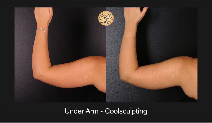 Coolsculpting Arms Before & After