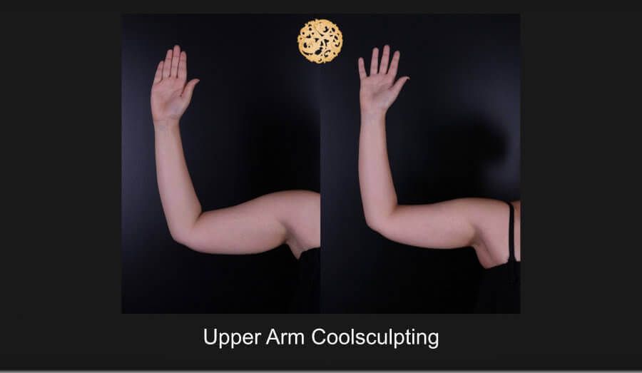 Coolsculpting Arms Before & After