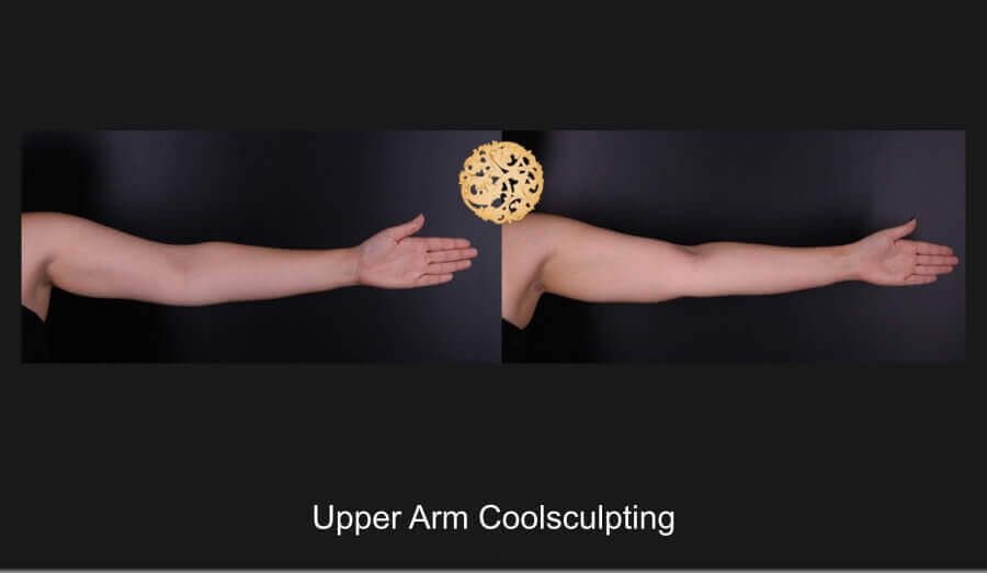 Coolsculpting Arms Before & After