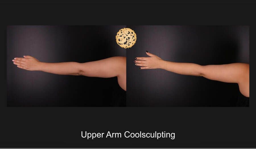 Coolsculpting Arms Before & After