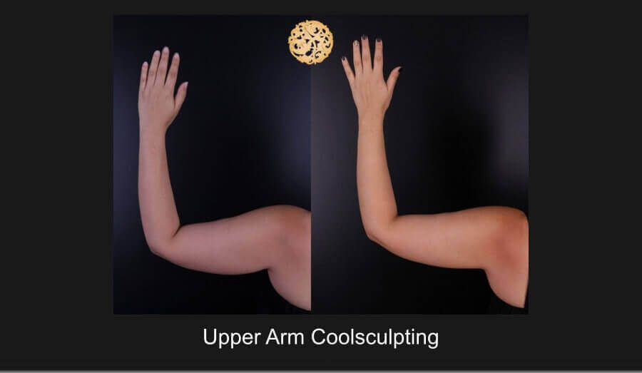 Coolsculpting Arms Before & After