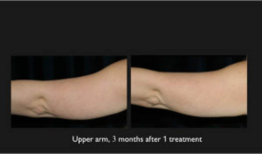Coolsculpting Arms Before & After