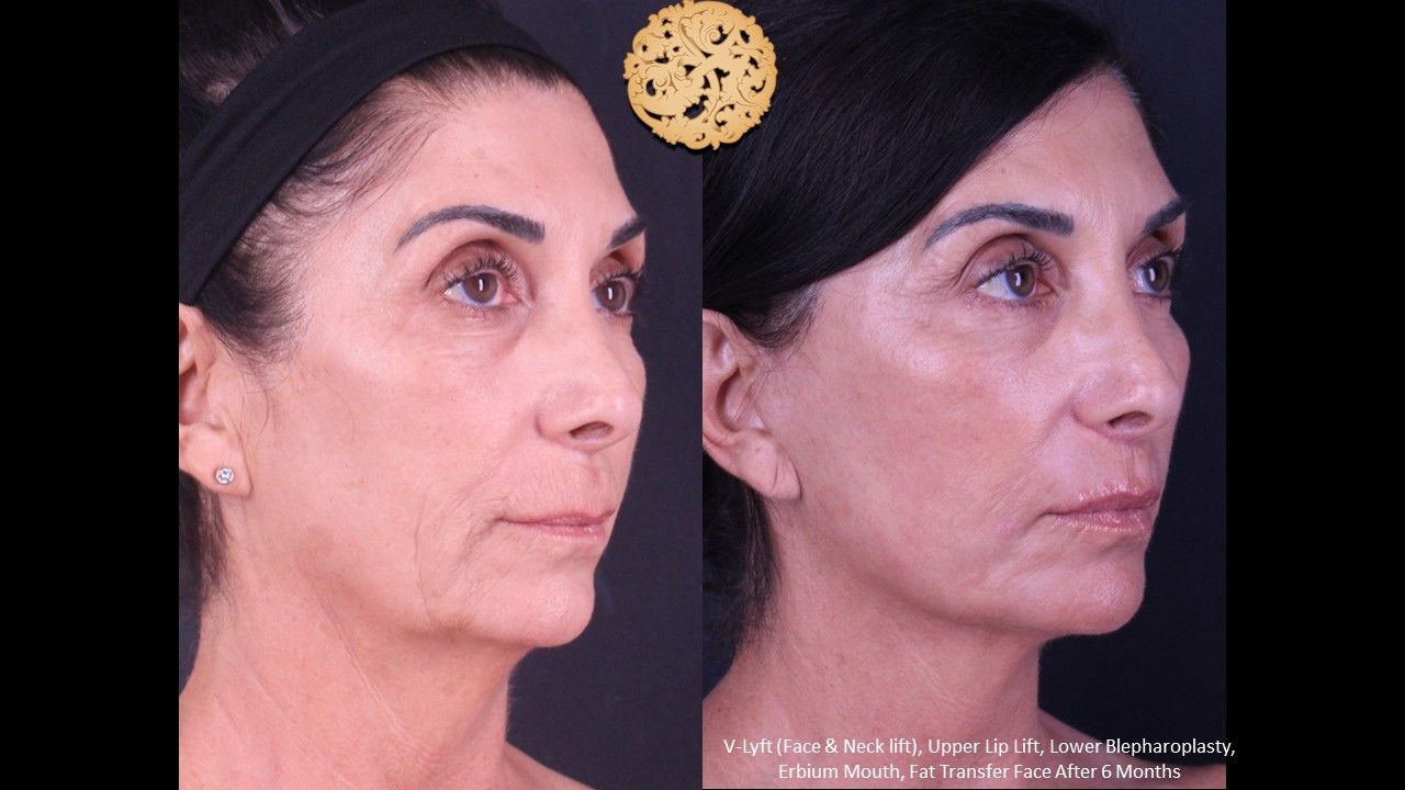 Lower Blepharoplasty Before & After