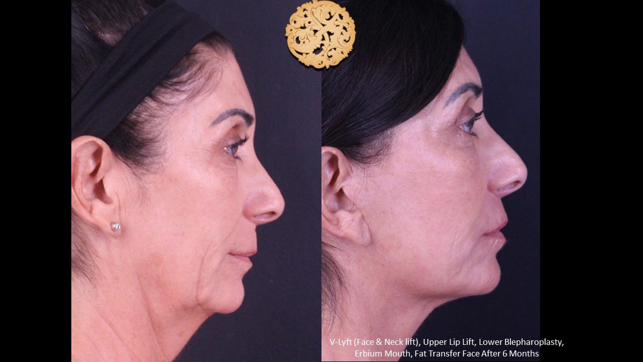 Lower Blepharoplasty Before & After