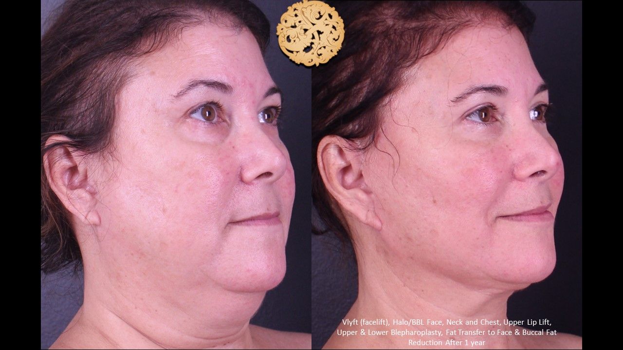 Lower Blepharoplasty Before & After