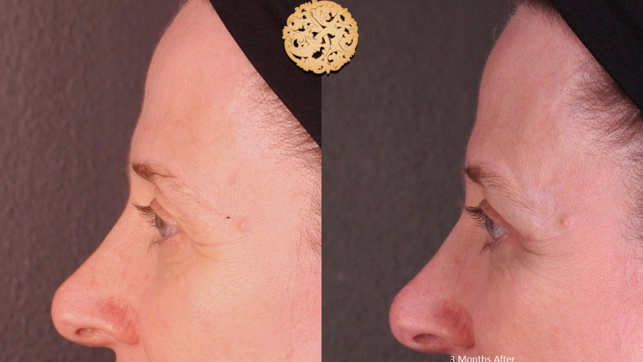 Lower Blepharoplasty Before & After