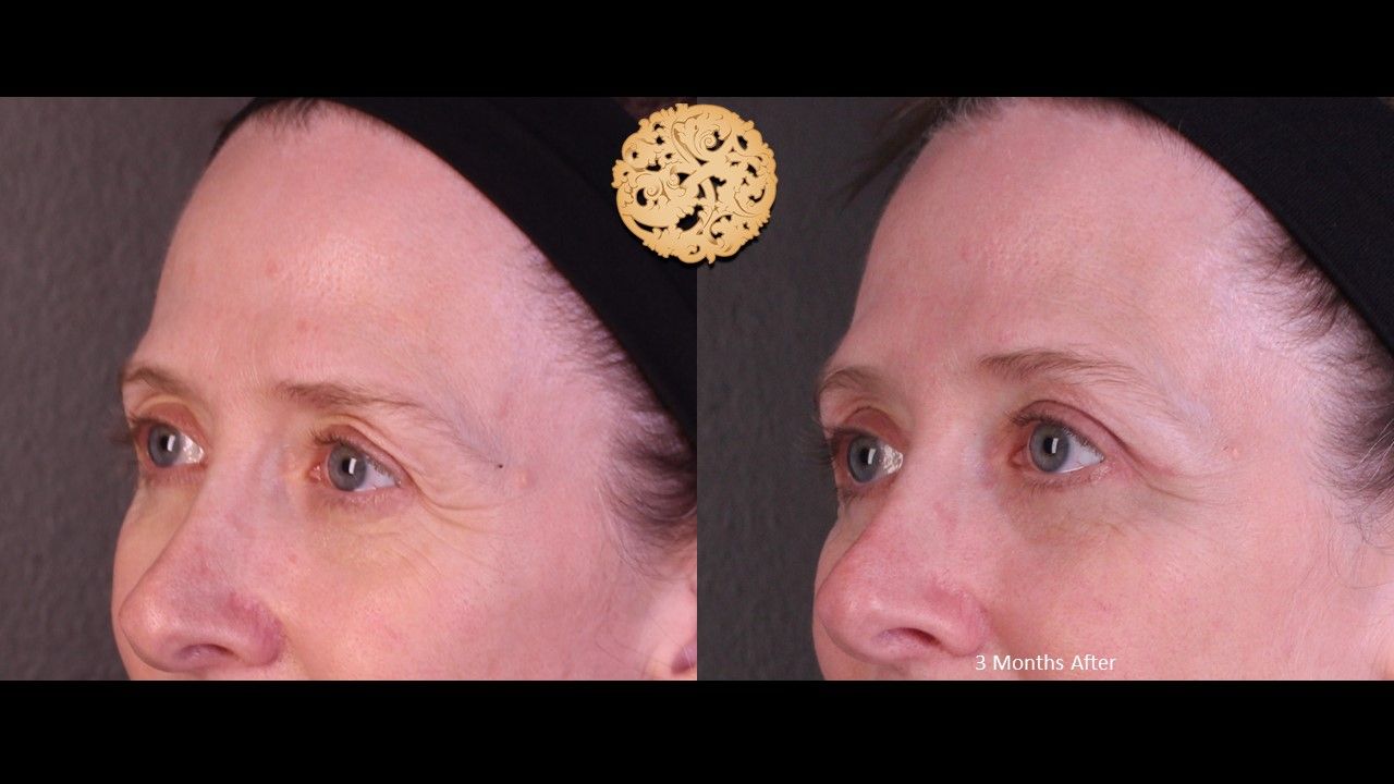 Lower Blepharoplasty Before & After