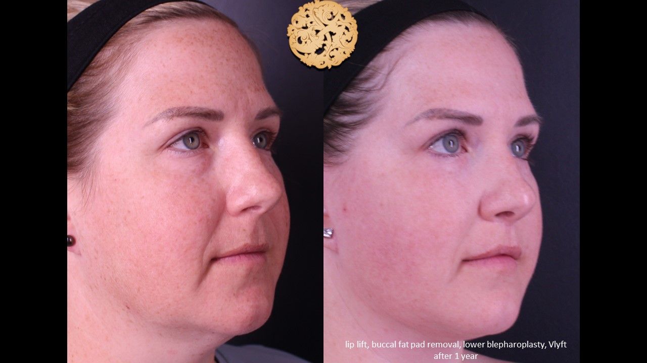 Lower Blepharoplasty Before & After