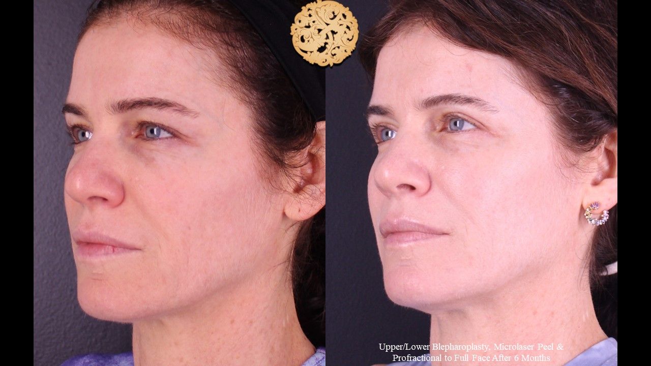 Lower Blepharoplasty Before & After