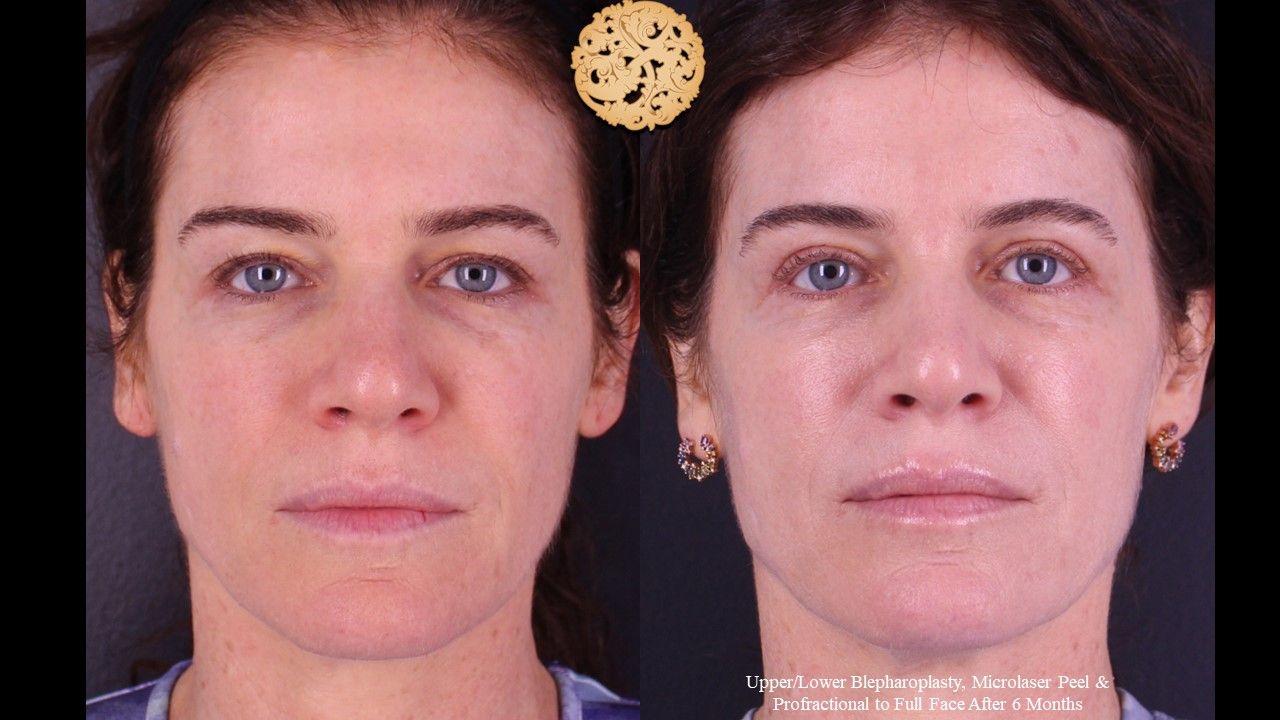 Lower Blepharoplasty Before & After